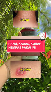 Obat Panu Kadas Kurap Herbal Alami dan Cara buatnya