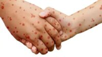 Beda Hantavirus dan Campak